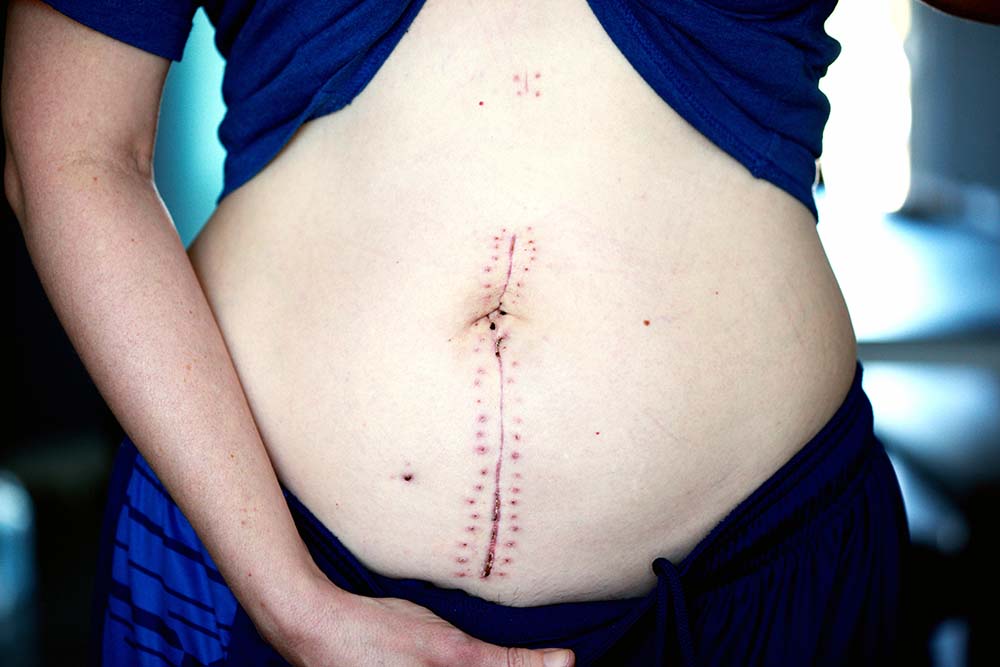 8 THINGS TO AVOID AFTER A CESAREAN OPERATION