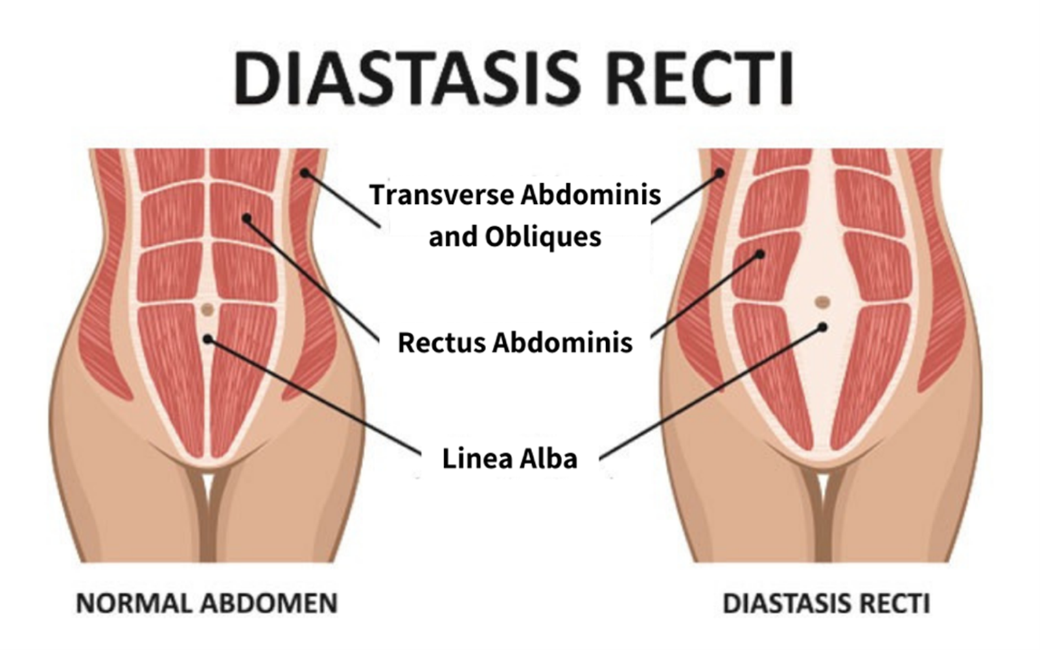 Facts and Tips for Healing Diastasis Recti, Part 1