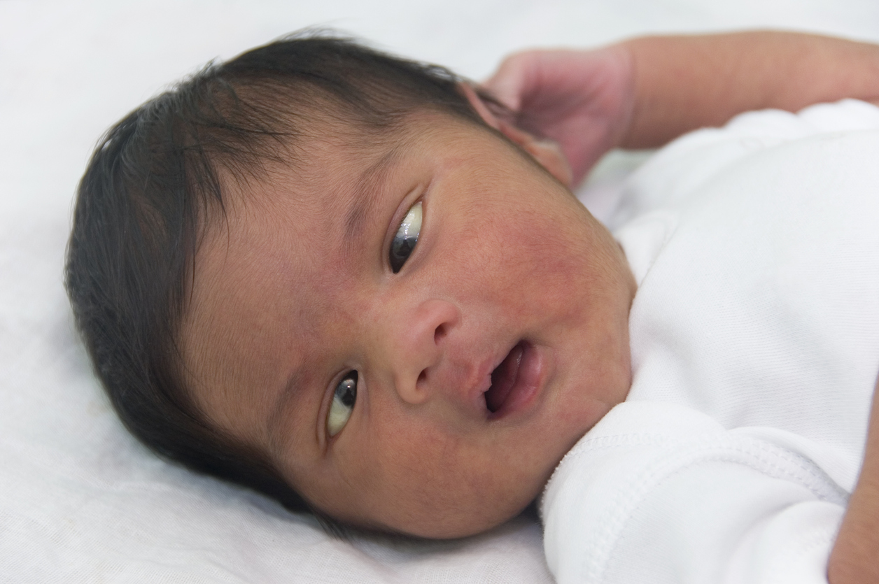 Cross-Eyed Baby: What It Means and What To Do